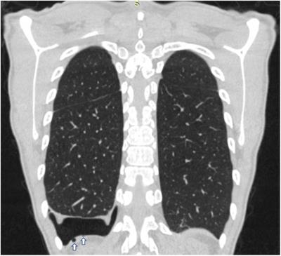 Catamenial pneumothorax: Not only VATS diagnosis